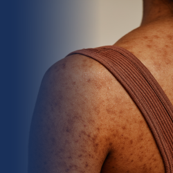Skin Disorders
