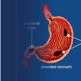 Peptic Ulcers